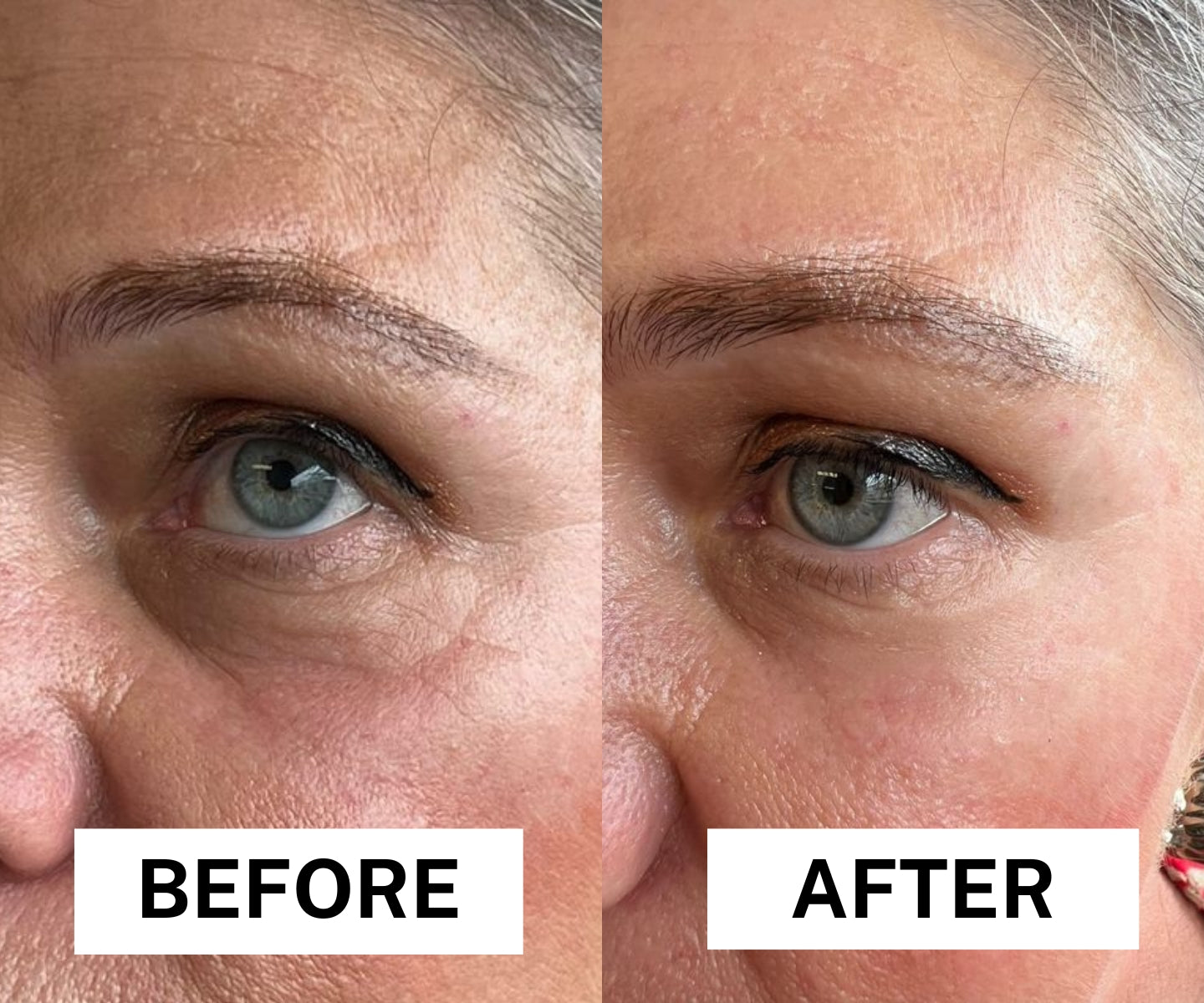 Tenseur temporaire pour les yeux et visage instantanée .